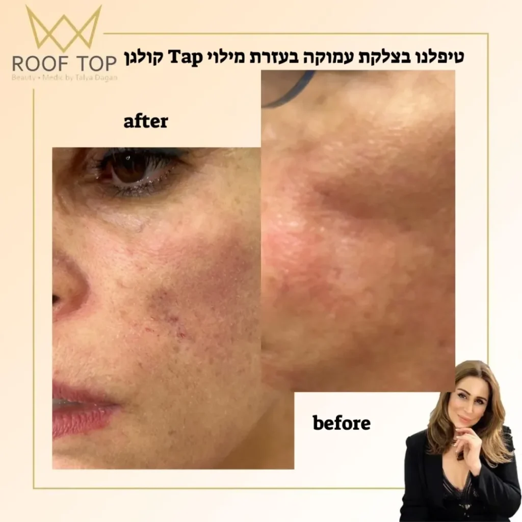 טיפול בצלקת עמוקה במילוי קולגן — לפני ואחרי, קליניקת טליה דגן ברחובות